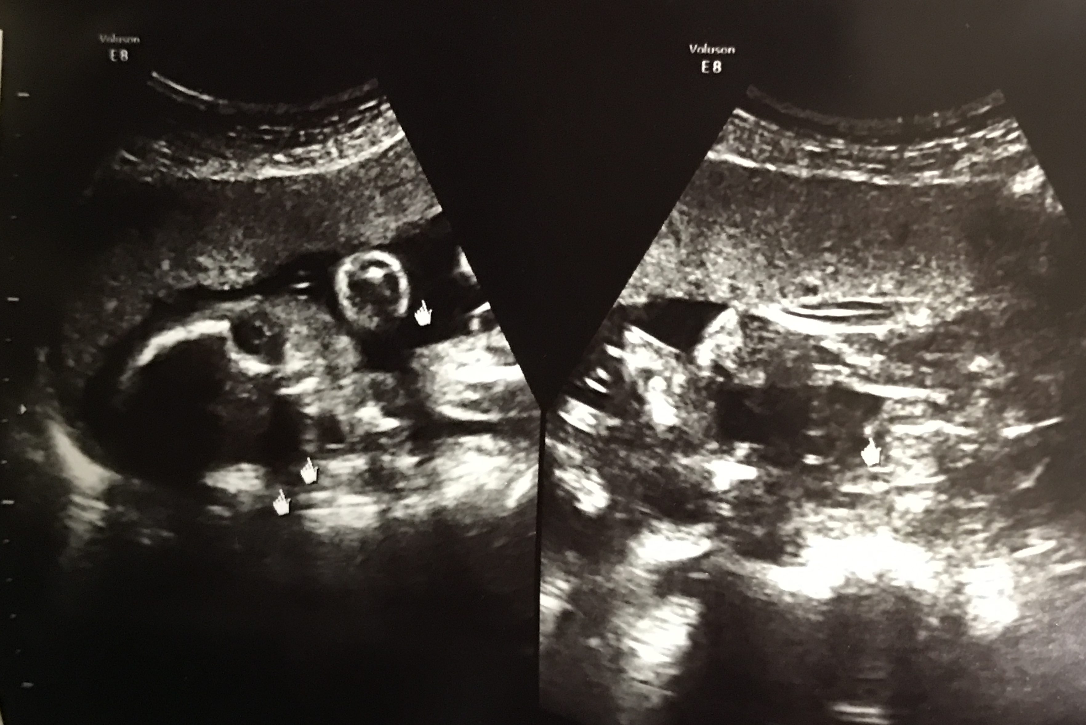 妊娠6か月エコー写真